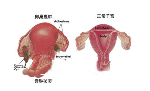成都治疗卵巢囊肿效果好的医院